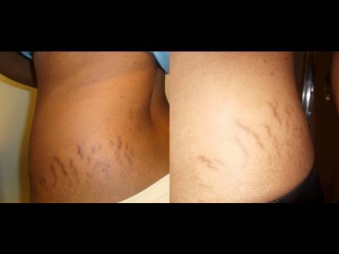 Best Natural Stretch Mark Oil For Pregnancy Best Natural Stretch Mark Oil For Pregnancy